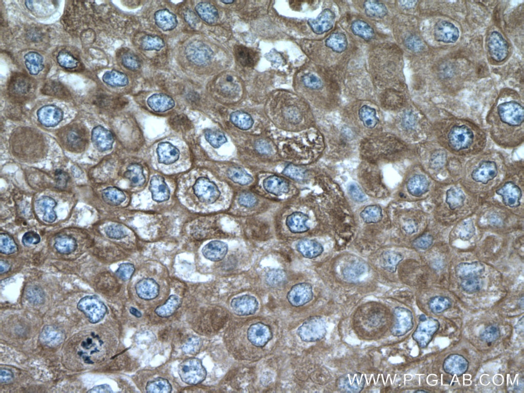 Immunohistochemistry (IHC) staining of human breast cancer tissue using GRP78/BIP Polyclonal antibody (11587-1-AP)