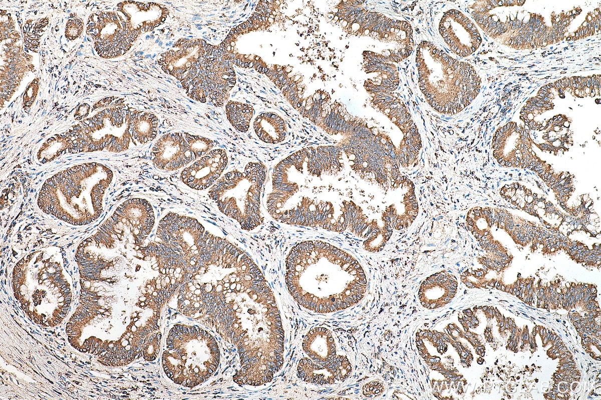 IHC staining of human pancreas cancer using 11587-1-AP