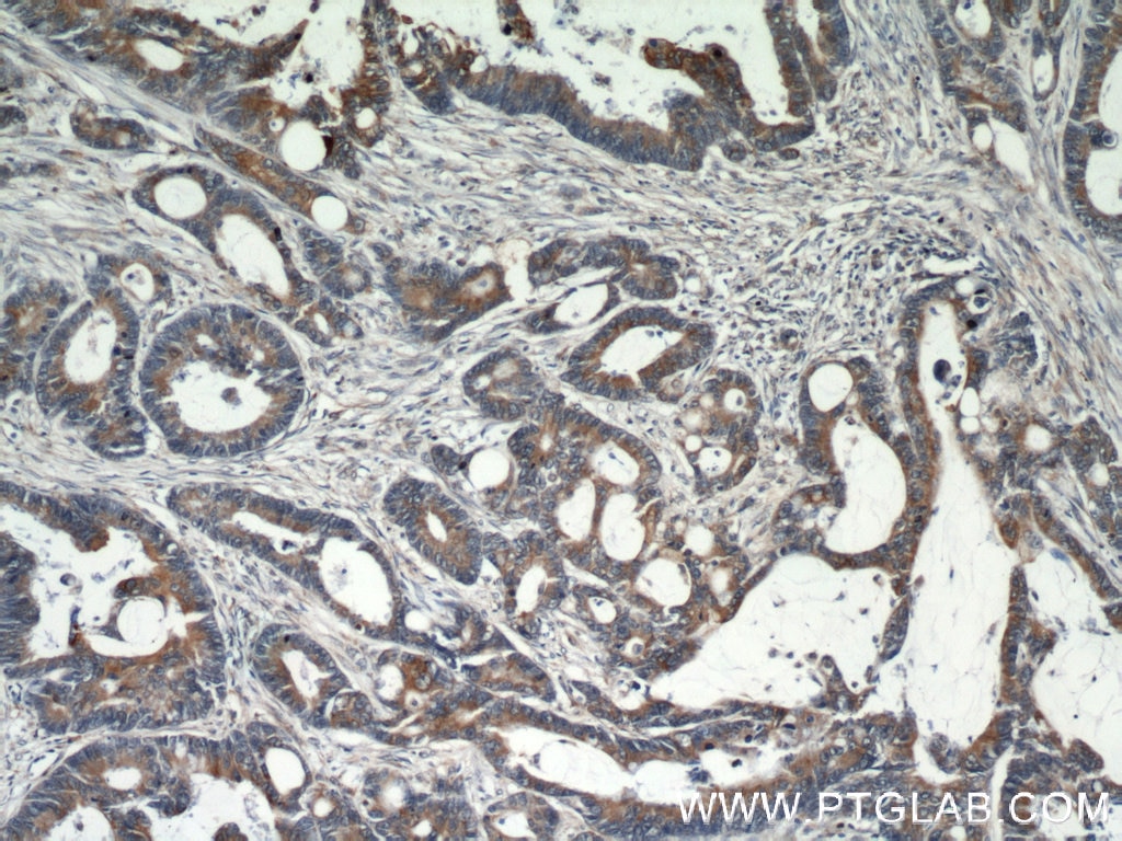 Immunohistochemistry (IHC) staining of human colon cancer tissue using GRP78/BIP Polyclonal antibody (11587-1-AP)