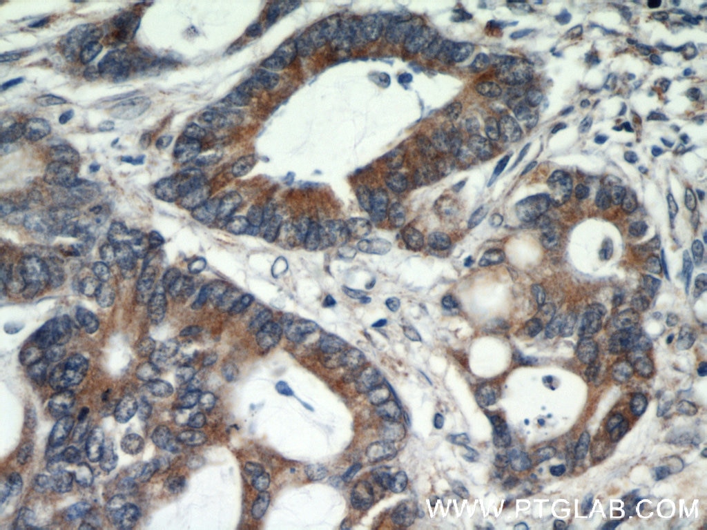 Immunohistochemistry (IHC) staining of human colon cancer tissue using GRP78/BIP Polyclonal antibody (11587-1-AP)