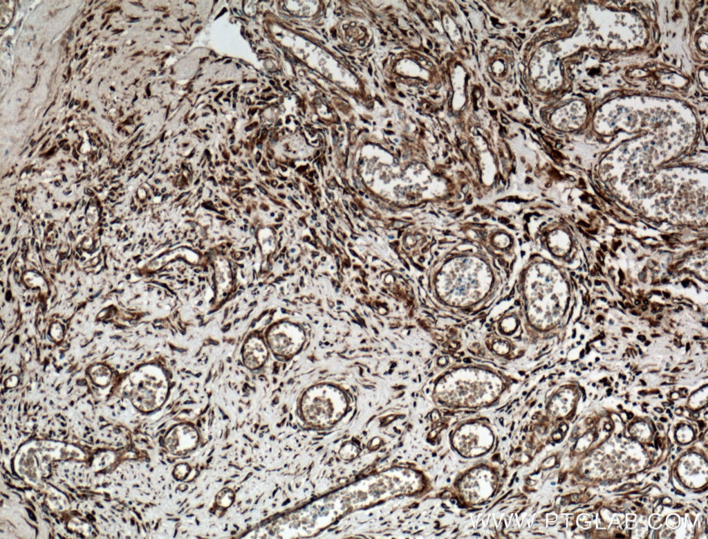 Immunohistochemistry (IHC) staining of human colon cancer tissue using GRP78/BIP Monoclonal antibody (66574-1-Ig)