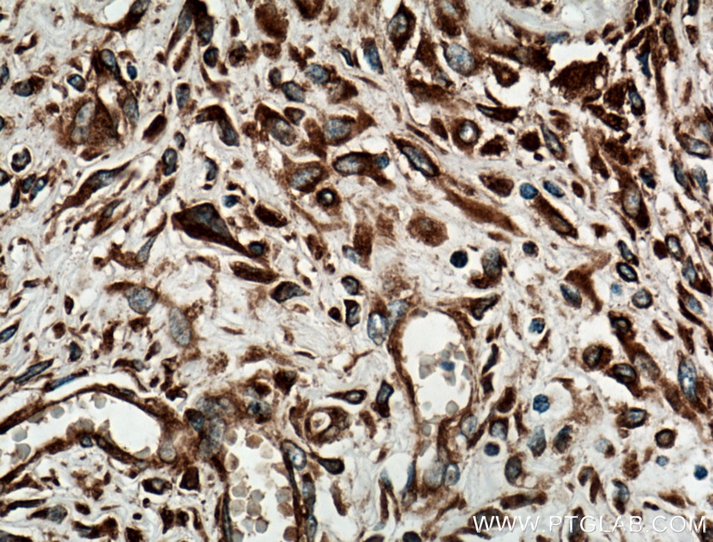 Immunohistochemistry (IHC) staining of human colon cancer tissue using GRP78/BIP Monoclonal antibody (66574-1-Ig)