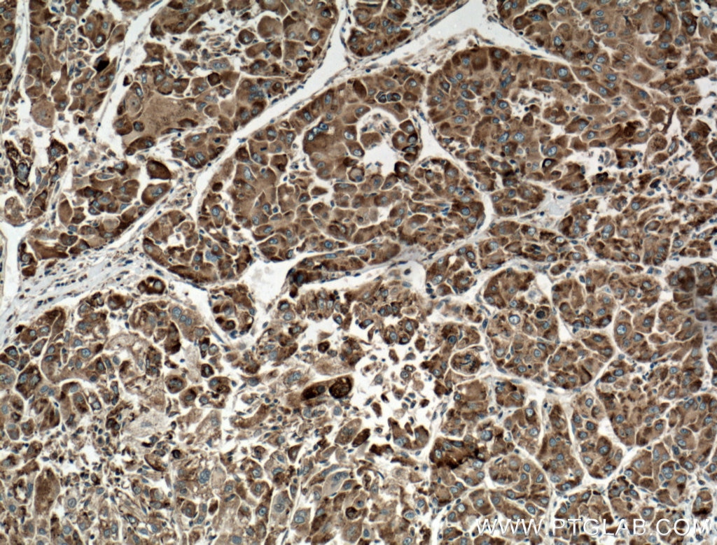 Immunohistochemistry (IHC) staining of human liver cancer tissue using GRP78/BIP Monoclonal antibody (66574-1-Ig)