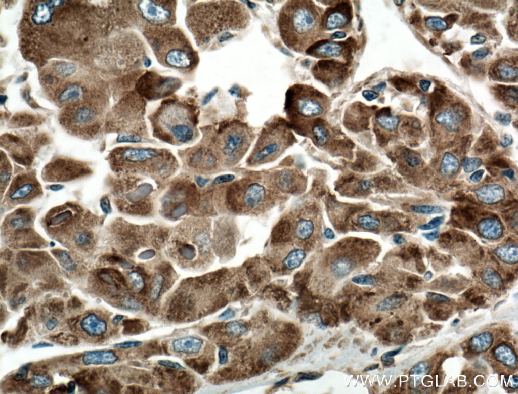 Immunohistochemistry (IHC) staining of human liver cancer tissue using GRP78/BIP Monoclonal antibody (66574-1-Ig)