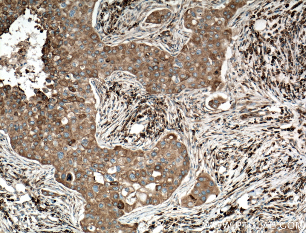 Immunohistochemistry (IHC) staining of human breast cancer tissue using GRP78/BIP Monoclonal antibody (66574-1-Ig)