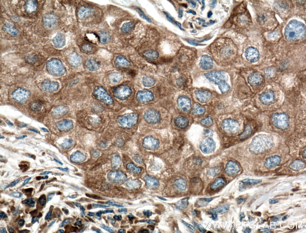 Immunohistochemistry (IHC) staining of human breast cancer tissue using GRP78/BIP Monoclonal antibody (66574-1-Ig)