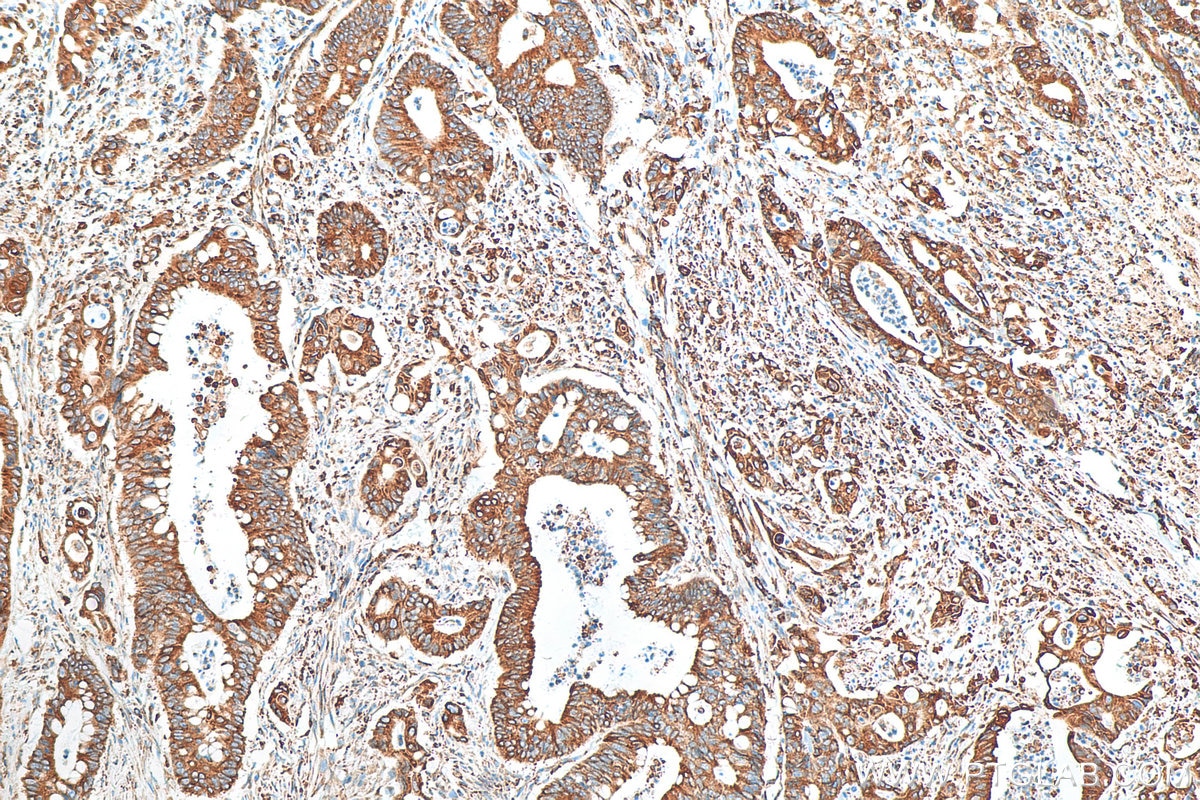 Immunohistochemistry (IHC) staining of human colon cancer tissue using GRP78,BIP Recombinant antibody (80849-1-RR)