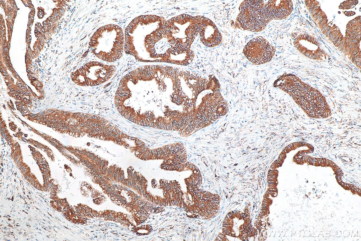 Immunohistochemistry (IHC) staining of human pancreas cancer tissue using GRP78,BIP Recombinant antibody (80849-1-RR)