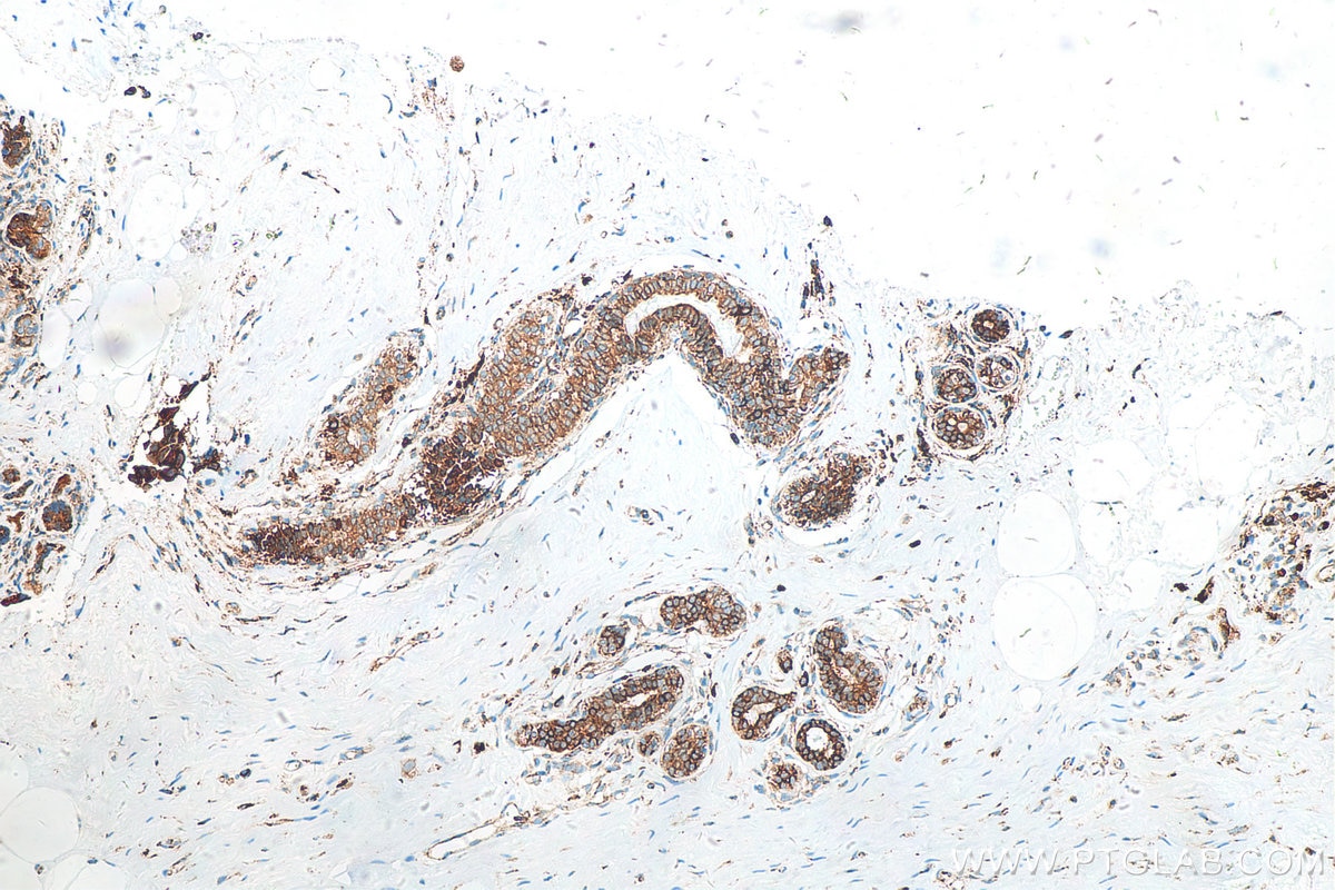 Immunohistochemistry (IHC) staining of human breast cancer tissue using GRP78,BIP Recombinant antibody (80849-1-RR)