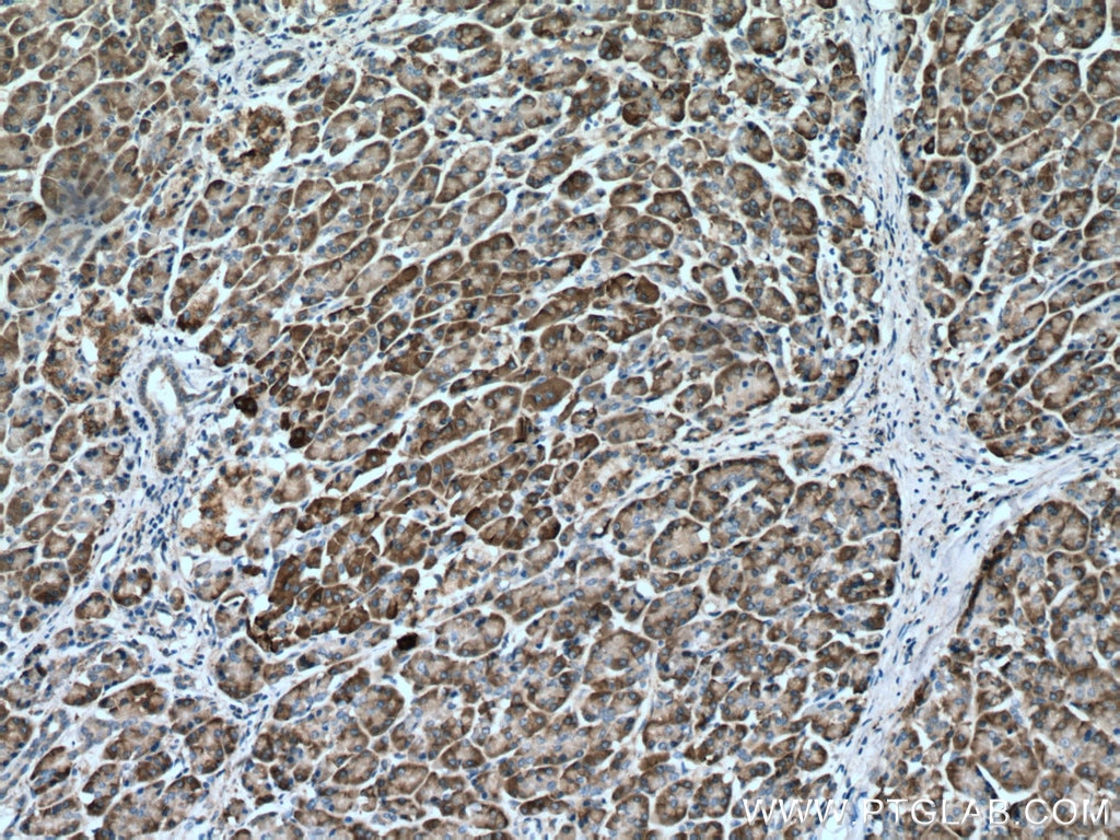 Immunohistochemistry (IHC) staining of human pancreas cancer tissue using GRP94 Monoclonal antibody (60012-2-Ig)
