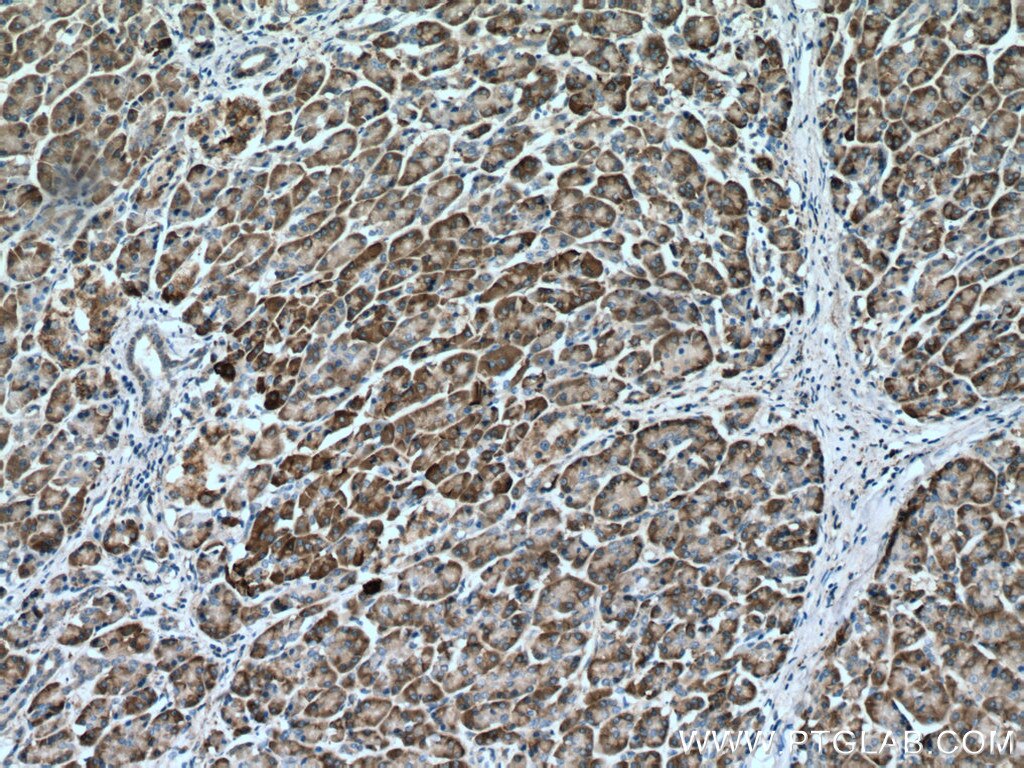 IHC staining of human pancreas cancer using 60012-2-Ig