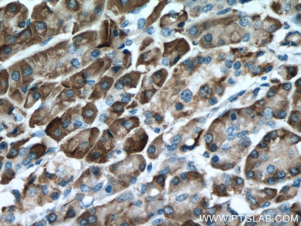 Immunohistochemistry (IHC) staining of human pancreas cancer tissue using GRP94 Monoclonal antibody (60012-2-Ig)