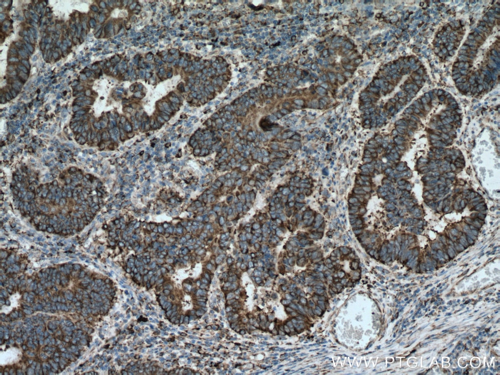 Immunohistochemistry (IHC) staining of human colon cancer tissue using GRP94 Monoclonal antibody (60012-2-Ig)
