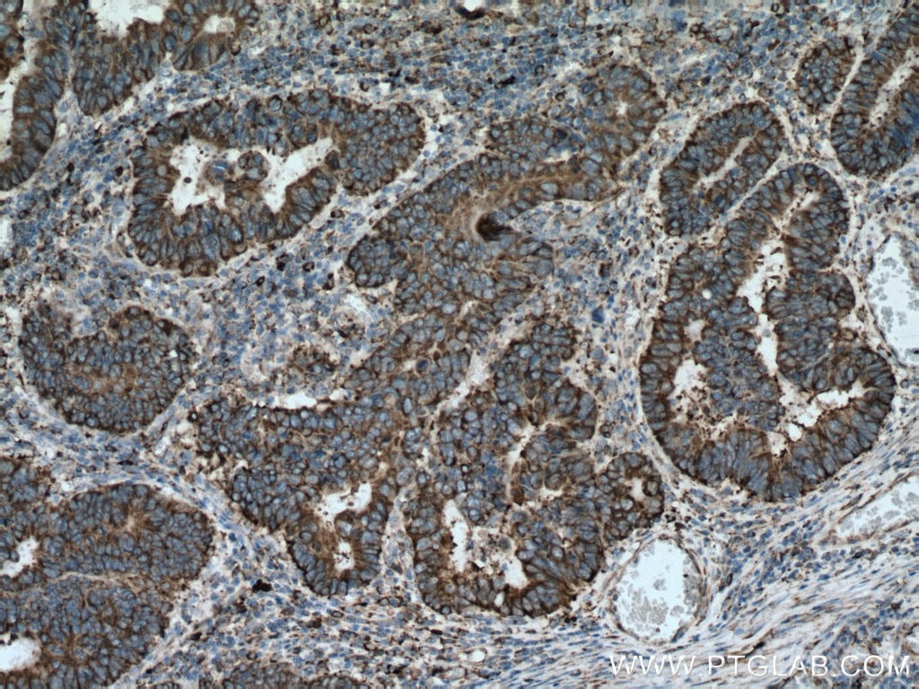 IHC staining of human colon cancer using 60012-2-Ig