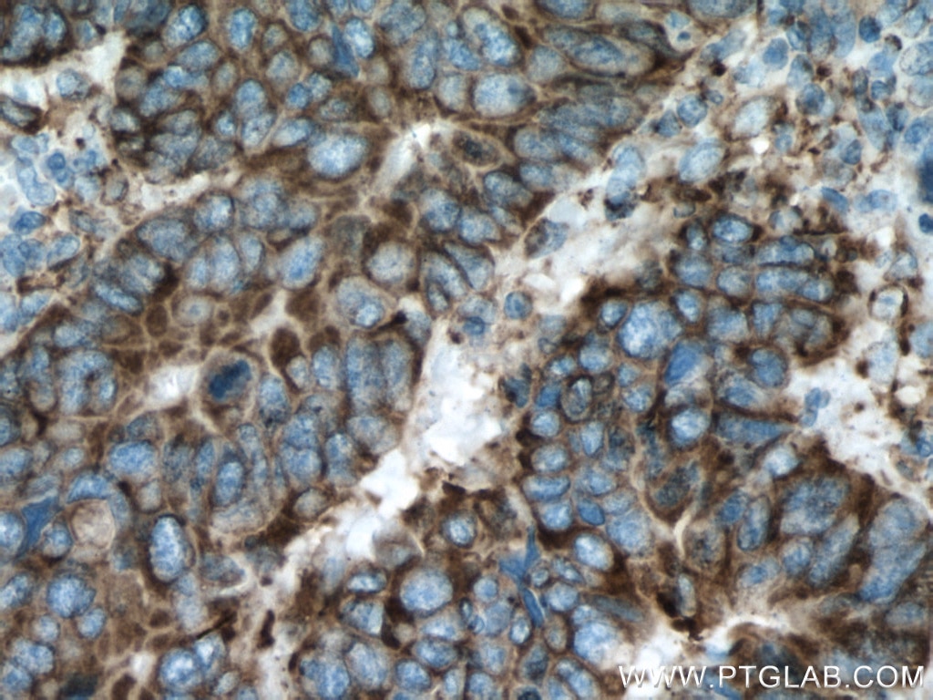 Immunohistochemistry (IHC) staining of human colon cancer tissue using GRP94 Monoclonal antibody (60012-2-Ig)