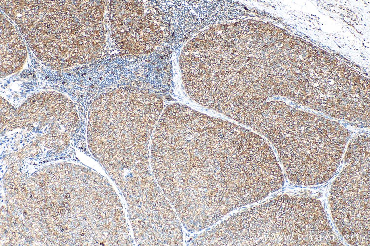 Immunohistochemistry (IHC) staining of human breast cancer tissue using GRP94 Recombinant antibody (82805-2-RR)