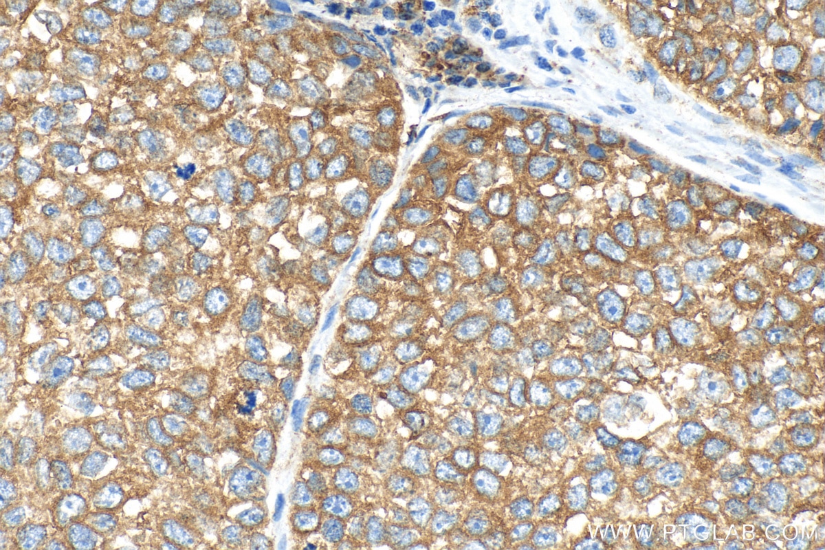 Immunohistochemistry (IHC) staining of human breast cancer tissue using GRP94 Recombinant antibody (82805-2-RR)