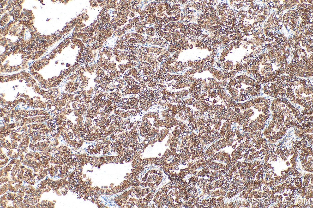 IHC staining of human lung cancer using 82805-2-RR