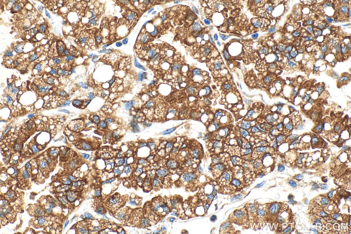 Immunohistochemistry (IHC) staining of human lung cancer tissue using GRP94 Recombinant antibody (82805-2-RR)