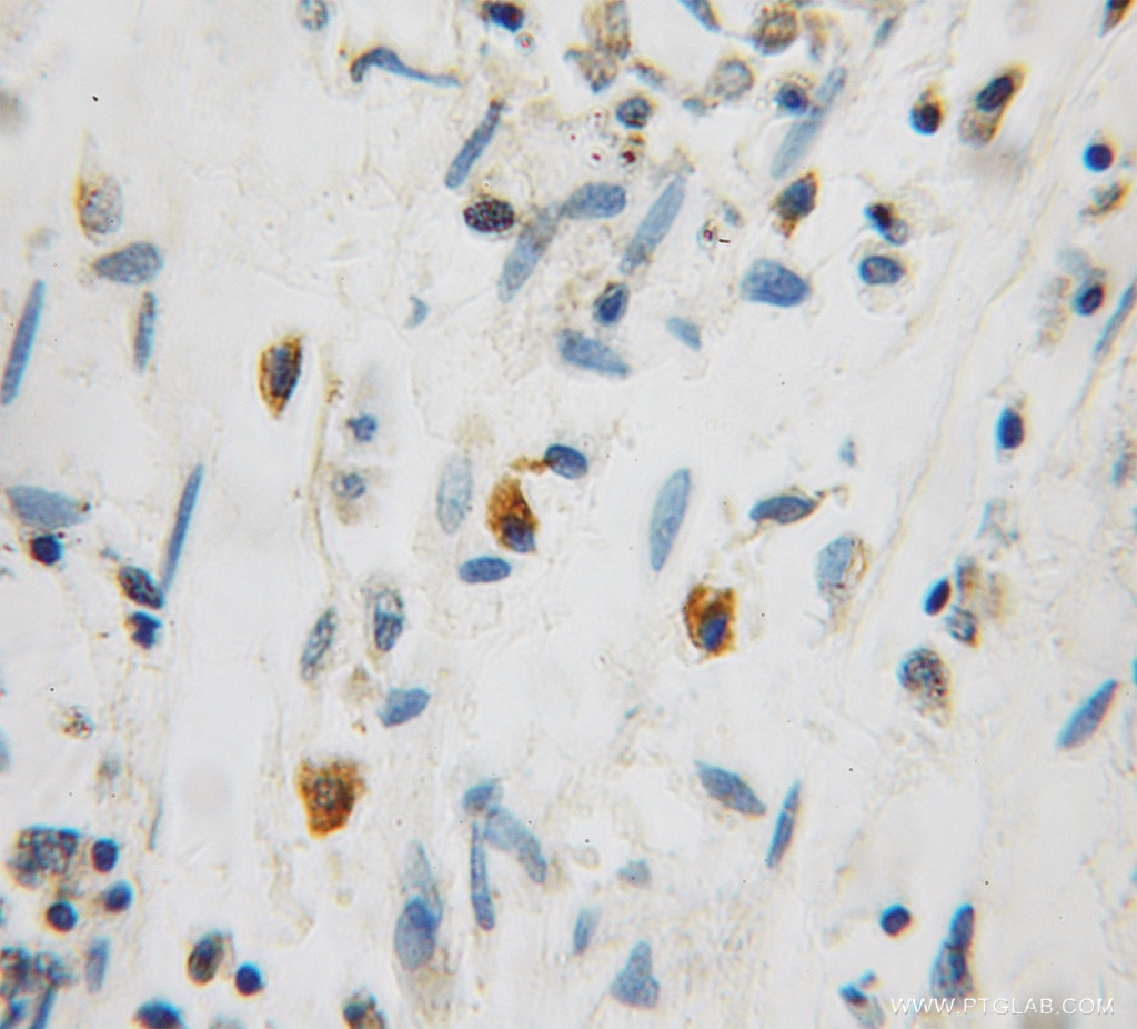 Immunohistochemistry (IHC) staining of human colon cancer tissue using GRPEL1 Polyclonal antibody (12720-1-AP)
