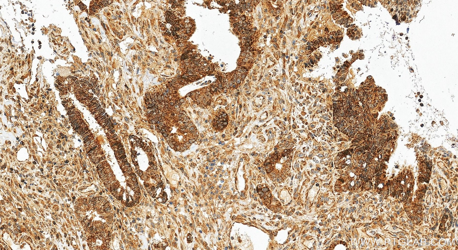 Immunohistochemistry (IHC) staining of human colon cancer tissue using GRSF1 Polyclonal antibody (30992-1-AP)