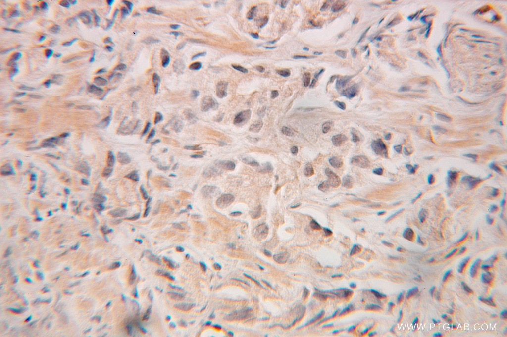 Immunohistochemistry (IHC) staining of human prostate cancer tissue using GRWD1 Polyclonal antibody (10354-1-AP)