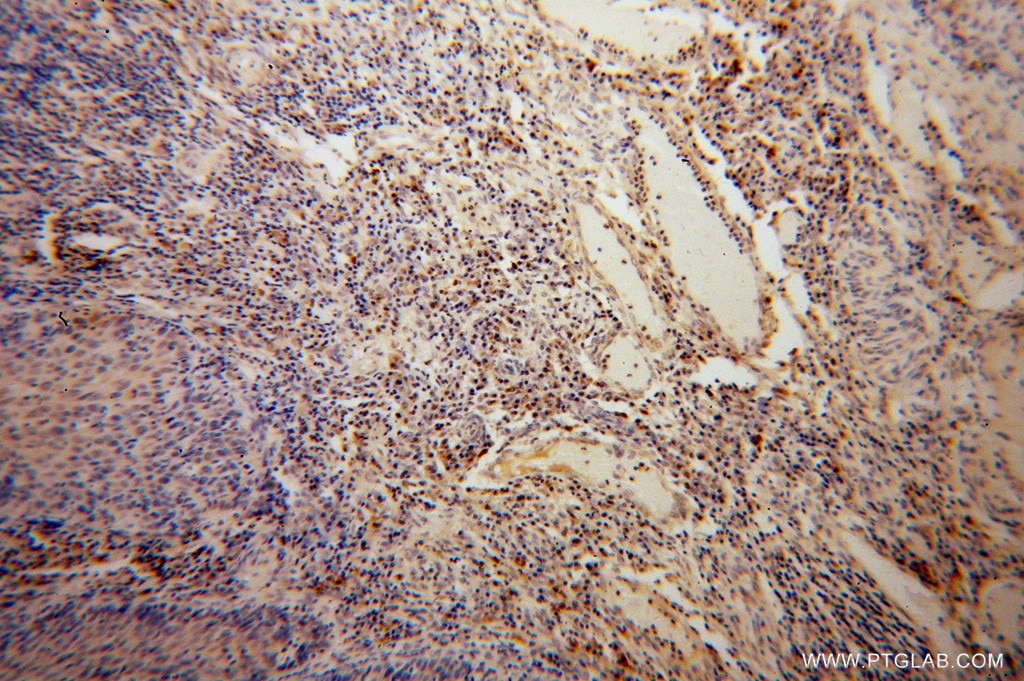 IHC staining of human cervical cancer using 14163-1-AP