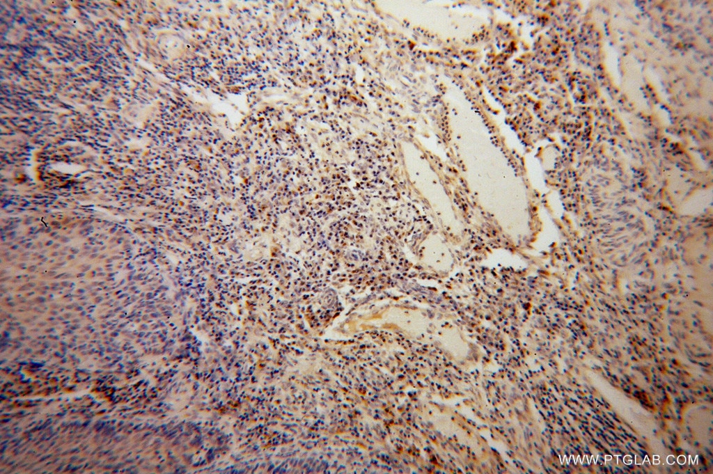 Immunohistochemistry (IHC) staining of human cervical cancer tissue using BET1L Polyclonal antibody (14163-1-AP)