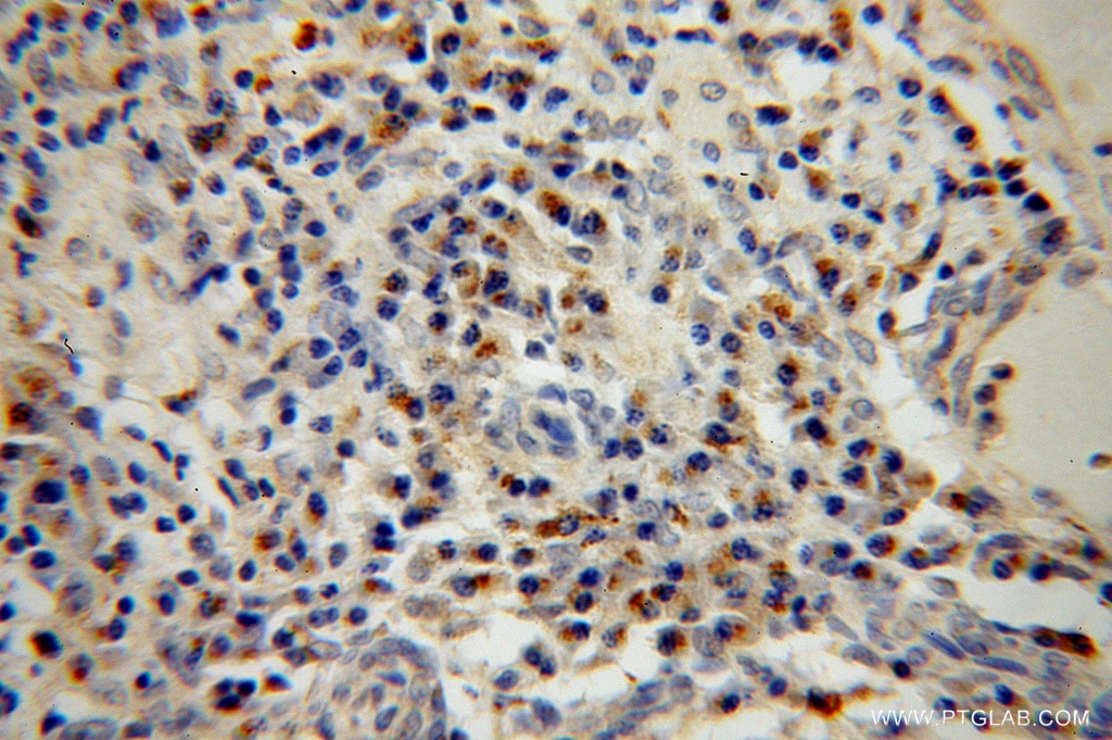Immunohistochemistry (IHC) staining of human cervical cancer tissue using BET1L Polyclonal antibody (14163-1-AP)