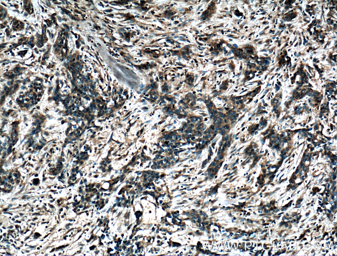 Immunohistochemistry (IHC) staining of human stomach cancer tissue using GS28 Polyclonal antibody (16106-1-AP)