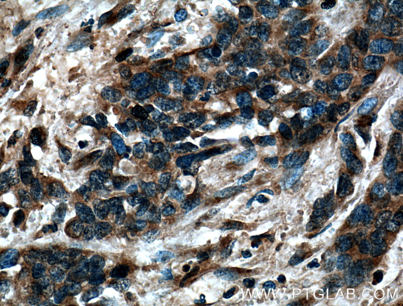 Immunohistochemistry (IHC) staining of human stomach cancer tissue using GS28 Polyclonal antibody (16106-1-AP)