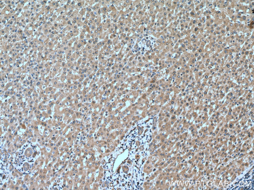 Immunohistochemistry (IHC) staining of human liver cancer tissue using GSDMB Polyclonal antibody (12885-1-AP)