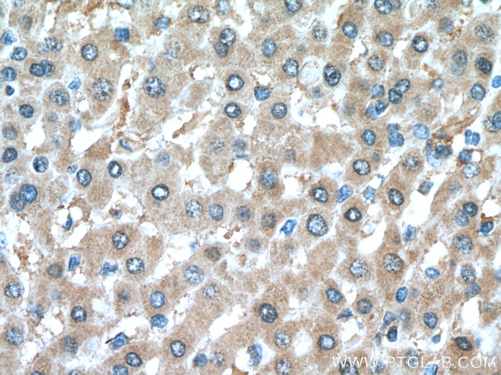 Immunohistochemistry (IHC) staining of human liver cancer tissue using GSDMB Polyclonal antibody (12885-1-AP)