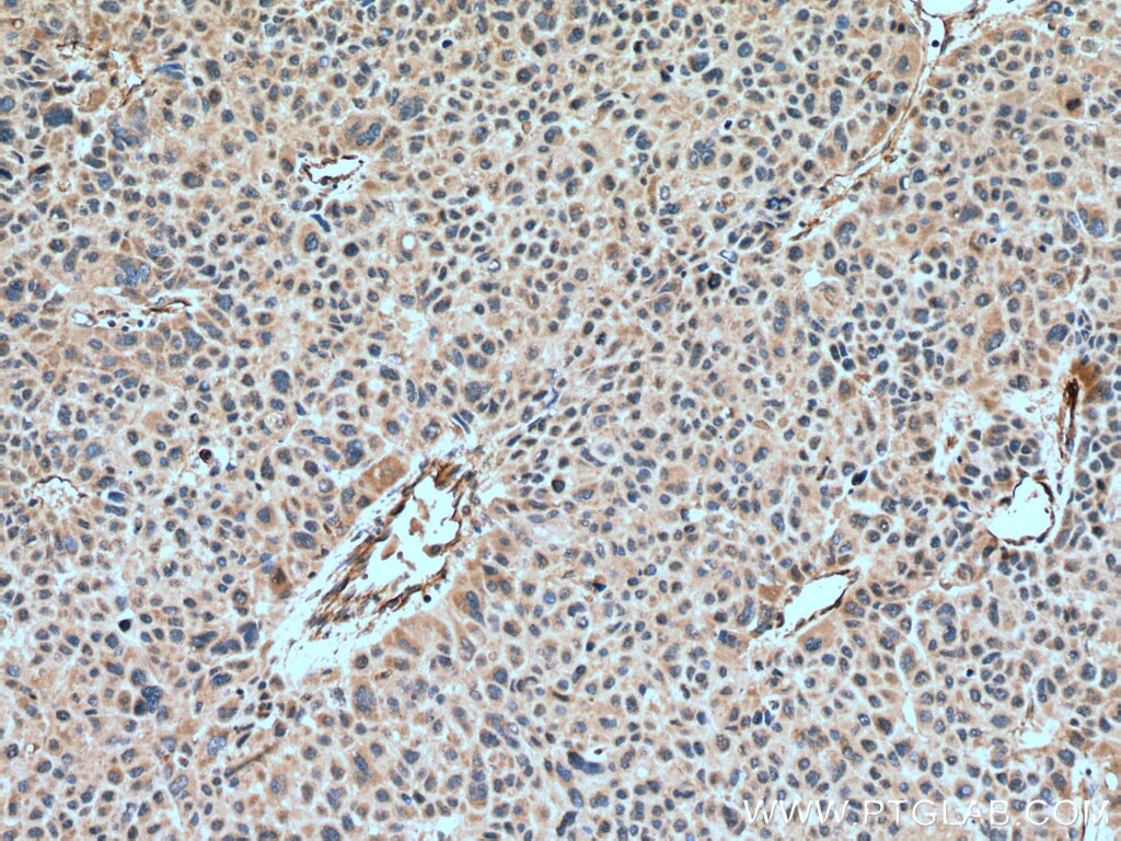 Immunohistochemistry (IHC) staining of human liver cancer tissue using GSDMB Polyclonal antibody (12885-1-AP)