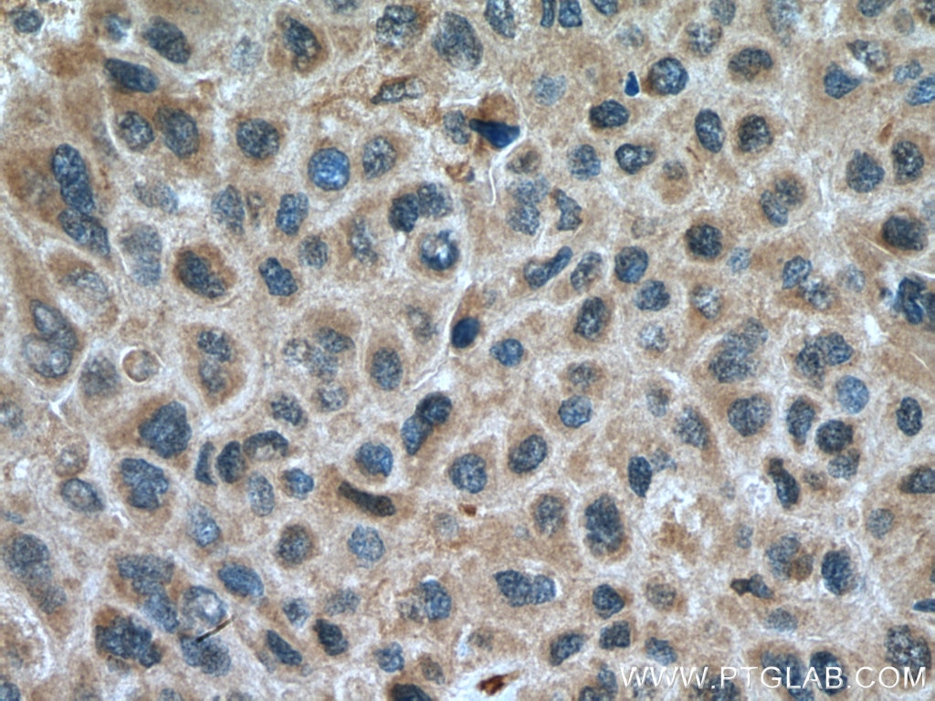 Immunohistochemistry (IHC) staining of human liver cancer tissue using GSDMB Polyclonal antibody (12885-1-AP)