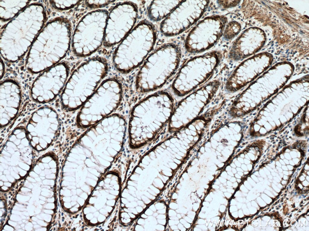 Immunohistochemistry (IHC) staining of human colon cancer tissue using GSDMB Polyclonal antibody (12885-1-AP)