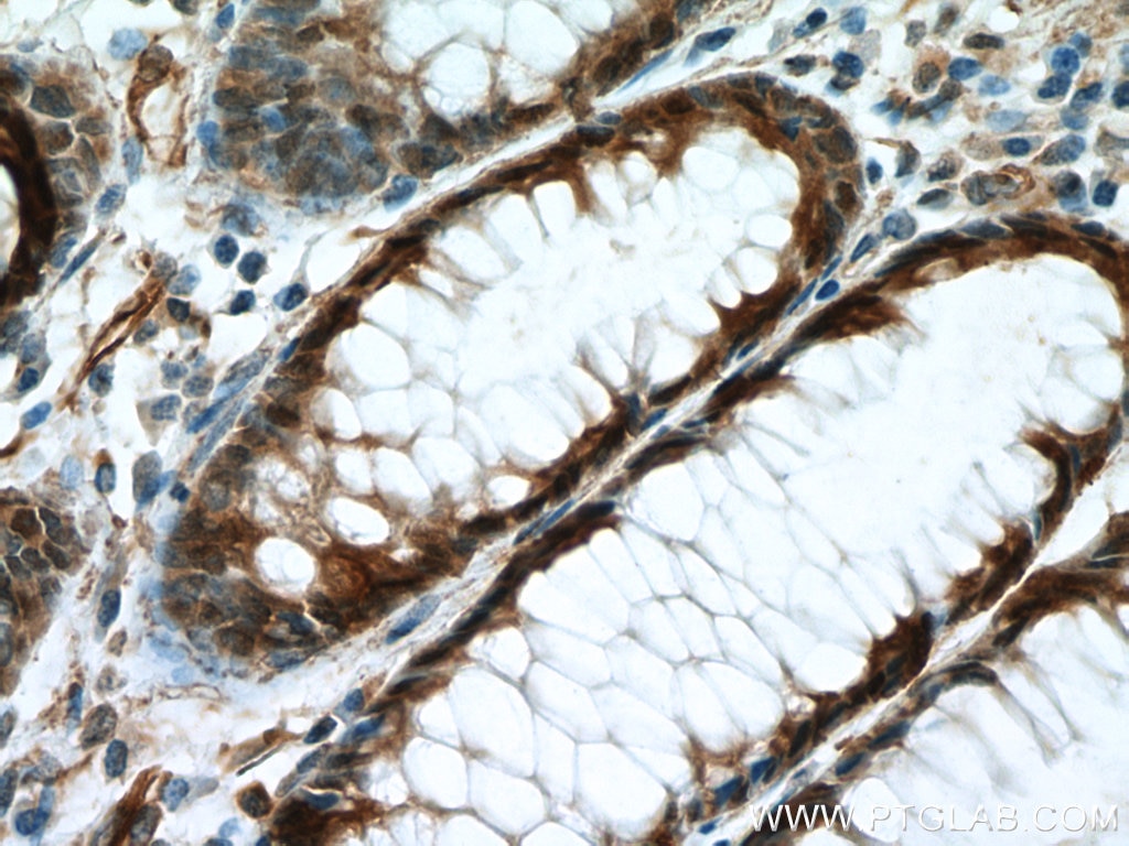 Immunohistochemistry (IHC) staining of human colon cancer tissue using GSDMB Polyclonal antibody (12885-1-AP)