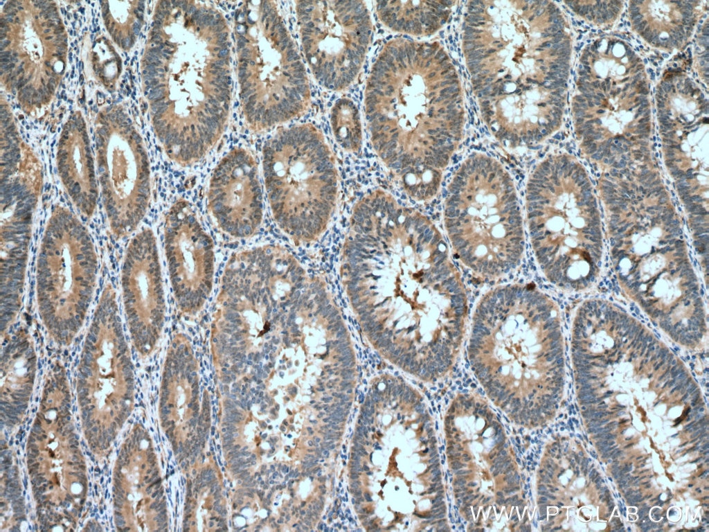 Immunohistochemistry (IHC) staining of human colon cancer tissue using GSDMB Polyclonal antibody (12885-1-AP)