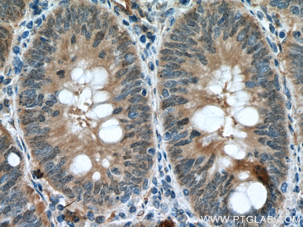 Immunohistochemistry (IHC) staining of human colon cancer tissue using GSDMB Polyclonal antibody (12885-1-AP)