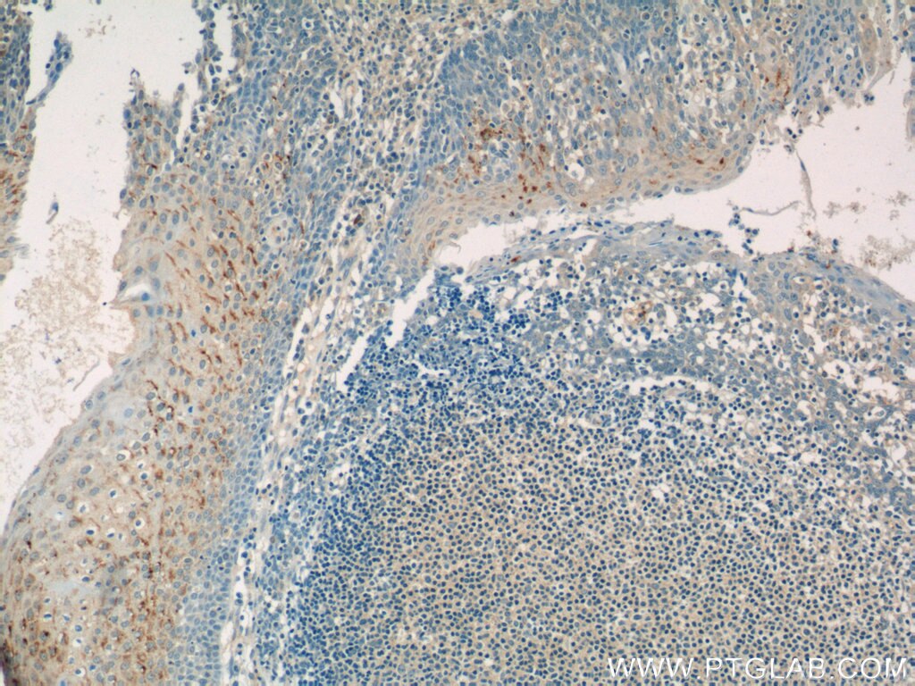 Immunohistochemistry (IHC) staining of human tonsillitis tissue using GSG1L Polyclonal antibody (17328-1-AP)