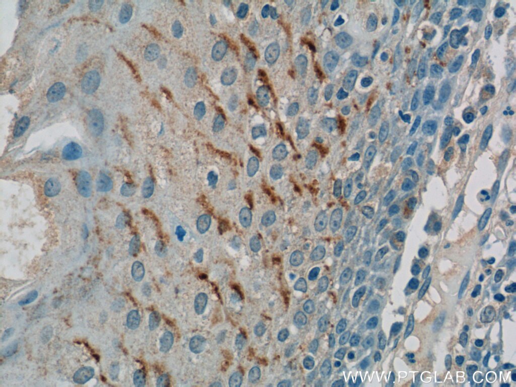 Immunohistochemistry (IHC) staining of human tonsillitis tissue using GSG1L Polyclonal antibody (17328-1-AP)