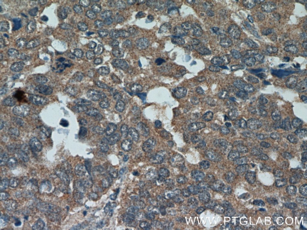 Immunohistochemistry (IHC) staining of human ovary tumor tissue using GSK3A Polyclonal antibody (13419-1-AP)