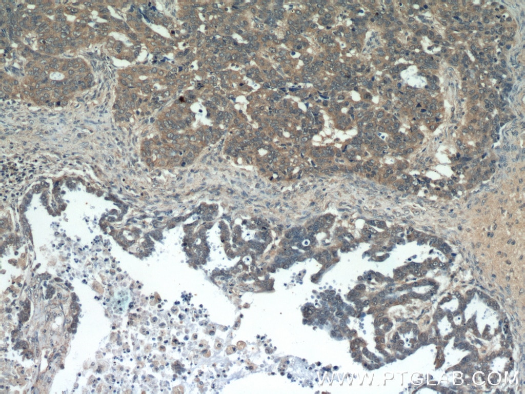 IHC staining of human ovary tumor using 13419-1-AP