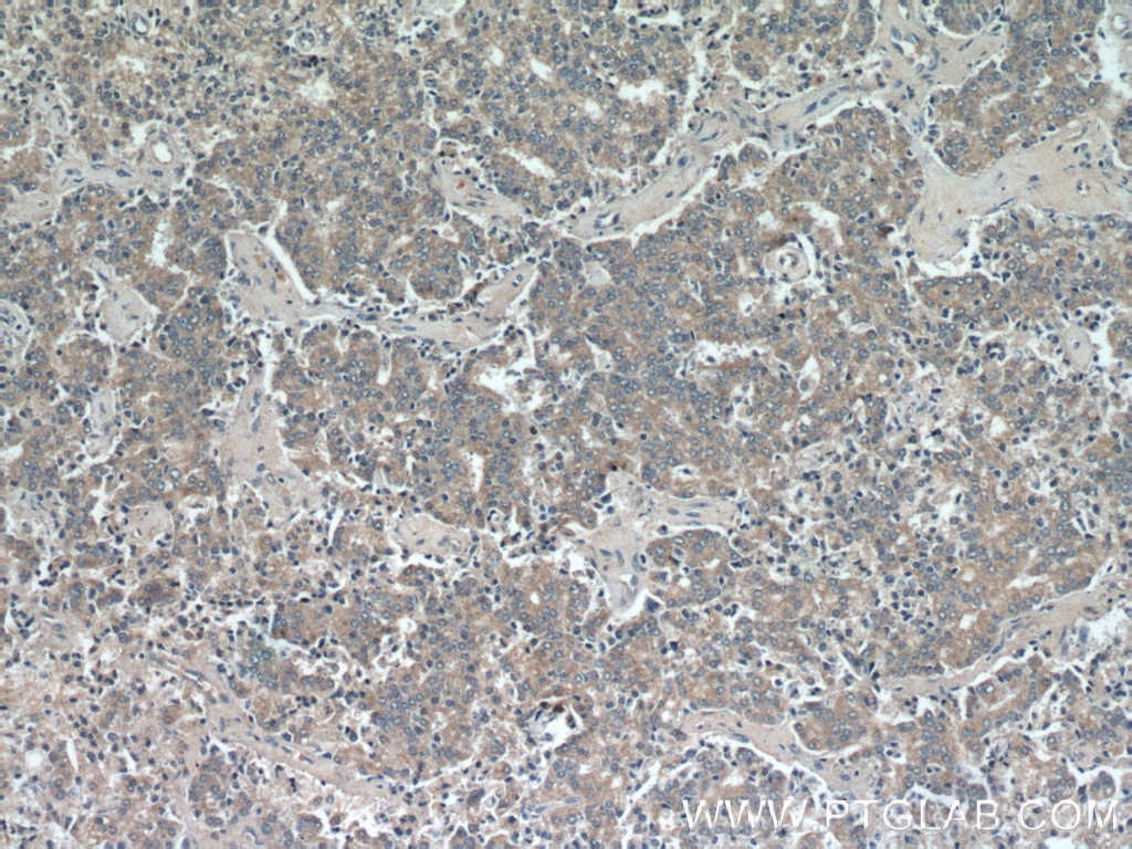 Immunohistochemistry (IHC) staining of human prostate cancer tissue using GSK3A Polyclonal antibody (13419-1-AP)