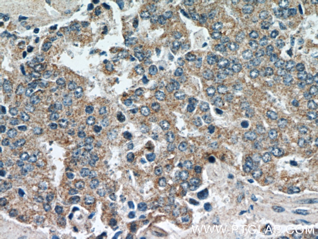 Immunohistochemistry (IHC) staining of human prostate cancer tissue using GSK3A Polyclonal antibody (13419-1-AP)