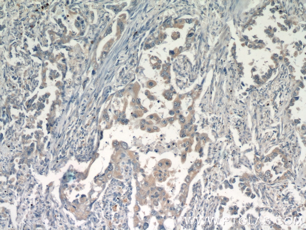 Immunohistochemistry (IHC) staining of human lung cancer tissue using GSK3A Polyclonal antibody (13419-1-AP)