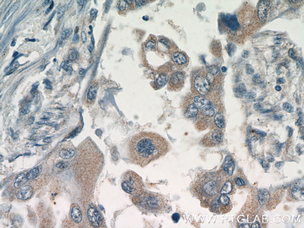 Immunohistochemistry (IHC) staining of human lung cancer tissue using GSK3A Polyclonal antibody (13419-1-AP)