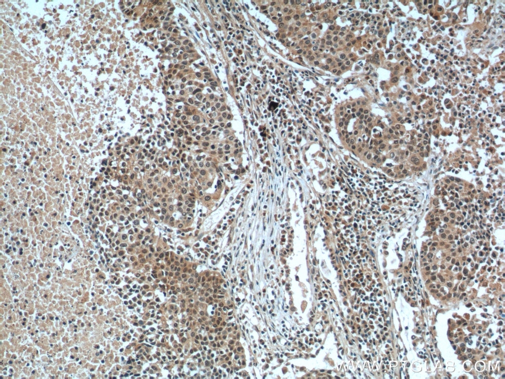 Immunohistochemistry (IHC) staining of human lung cancer tissue using GSK3B Polyclonal antibody (22104-1-AP)