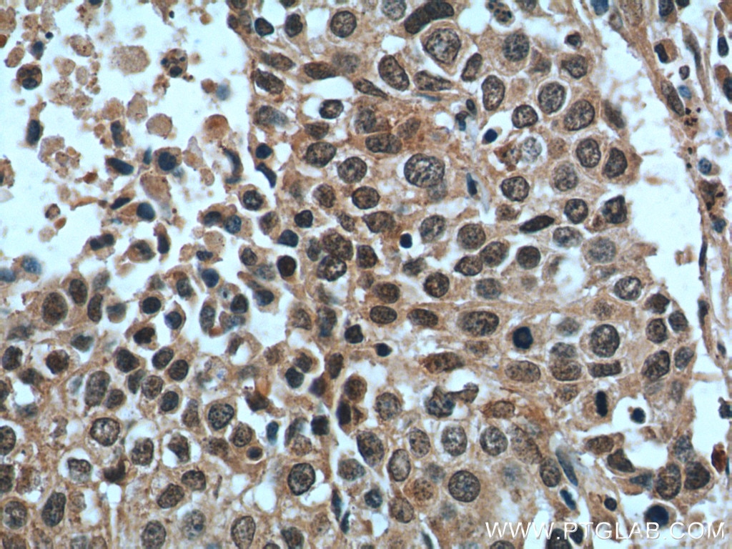 Immunohistochemistry (IHC) staining of human lung cancer tissue using GSK3B Polyclonal antibody (22104-1-AP)
