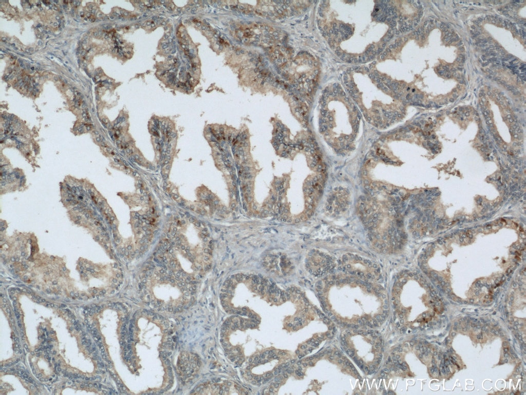 Immunohistochemistry (IHC) staining of human prostate hyperplasia tissue using GSK3B Polyclonal antibody (22104-1-AP)